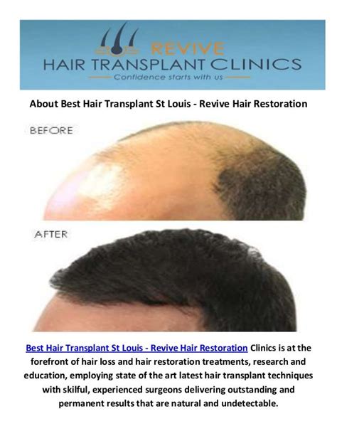 best mens hair restoration st louis